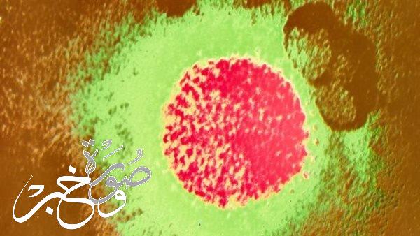حقائق ومعلومات عن حمى لاسا