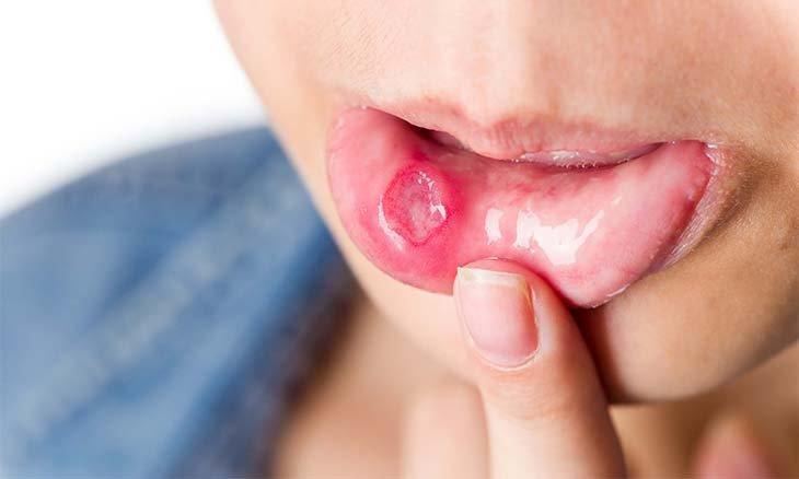 علاج تقرحات الفم بطرق طبيعية