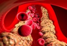 الكوليسترول وكيف يمكننا خفض مستوياته في الدم