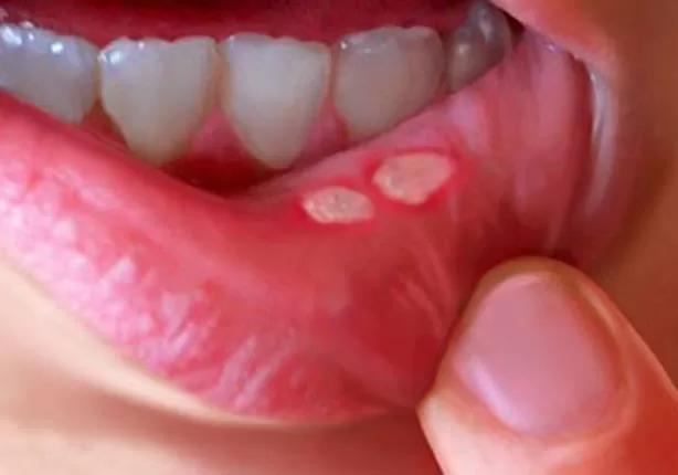 علاجات منزلية مذهلة لقرحة الفم